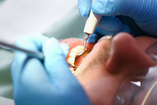 Best Emergency Tooth Extraction in Keowee Key, SC