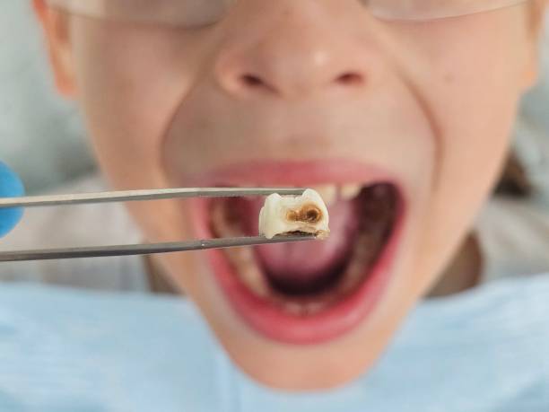 Best Emergency Treatment for Dental Infections or Abscesses in Keowee Key, SC